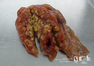 Visible TB lesions in lymph node caused by Mycobacterium caprae