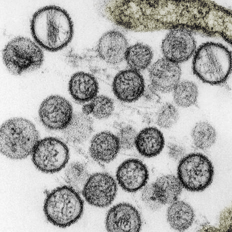 Hantavirus